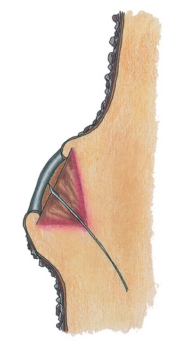 Entrée des microorganismes
